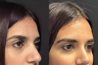 septoplasty in dubai