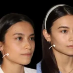 Sculptra Fillers Doctors in dubai