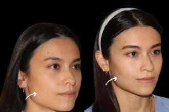 Sculptra Fillers Doctors in dubai