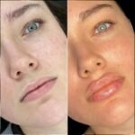 Fillers in Dubai
