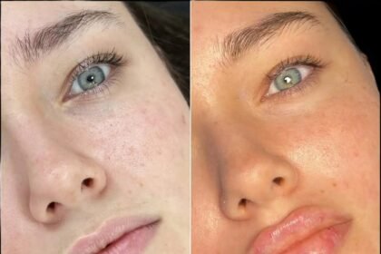 Fillers in Dubai