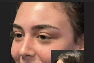rhinoplasty in dubai