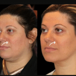 Sculptra Fillers in Dubai
