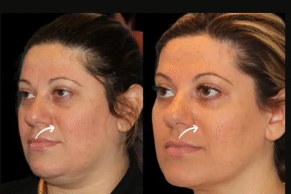 Sculptra Fillers in Dubai