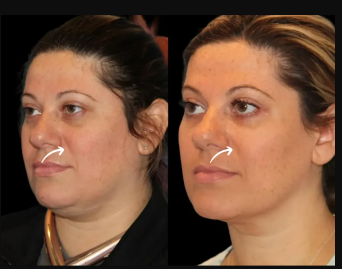 Sculptra Fillers in Dubai