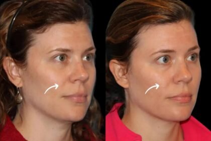 sculptra fillers in dubai